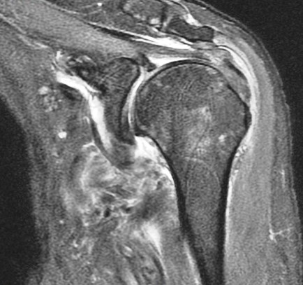 Figure 2 for case HAGL lesion and rotator cuff tears